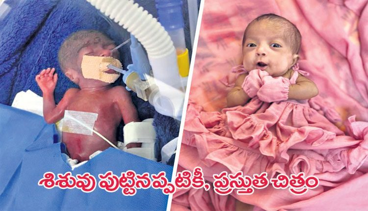 నెలలు నిండకుండా శిశువు జననం