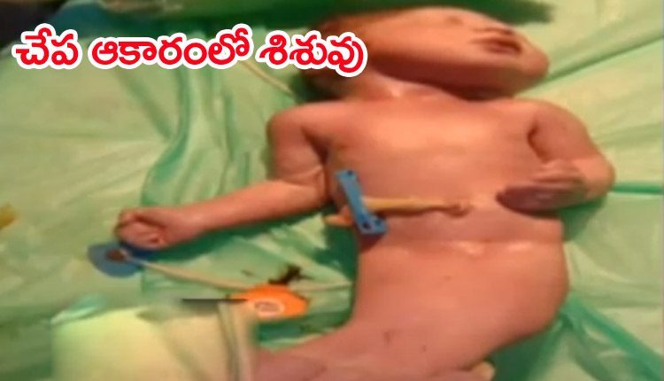పేట్ల బురుజు ఆస్ప‌త్రిలో వింత శిశువు జ‌న‌నం