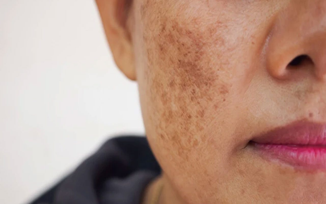 ముఖంపై గోధుమరంగు మచ్చలు.. బైబై చెప్పేందుకు చిట్కాలు