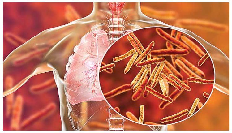 క్షయవ్యాధికి కారకాన్ని గుర్తించిన రాబర్ట్‌ కోచ్‌.. చరిత్రలో ఈరోజు