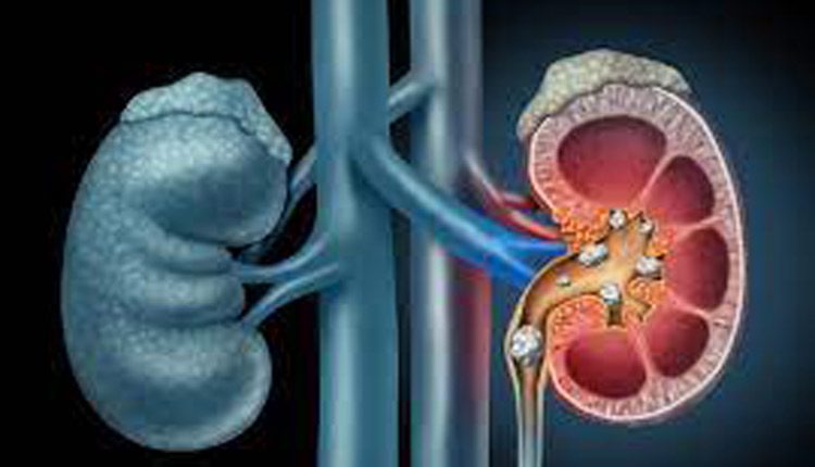 అంత‌ర్జాతీయ కిడ్నీ దినోత్స‌వం: కిడ్నీలో రాళ్లా? ఈ ఆహారం మానేయండి