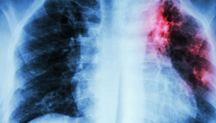 టీబీ నివారణలో తెలంగాణ బెస్ట్‌