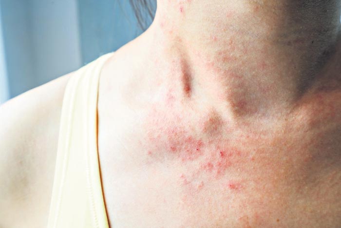 వైరస్‌తో చర్మసంబంధ సమస్యలు