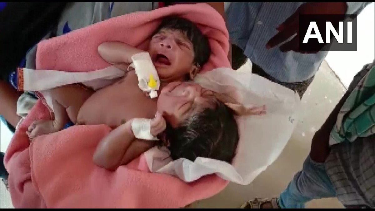 రెండు కాళ్లు, మూడు చేతుల‌తో.. ఒడిశాలో జ‌న్మించిన అవిభ‌క్త క‌వ‌ల‌లు