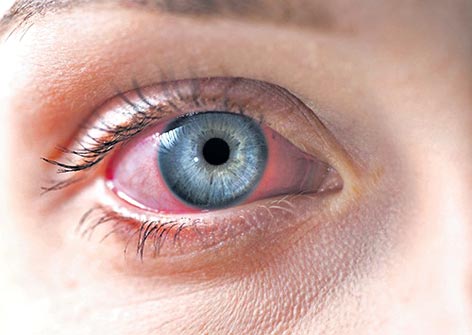 కొవిడ్‌ వచ్చిన వారిలో పింక్‌ ఐ!