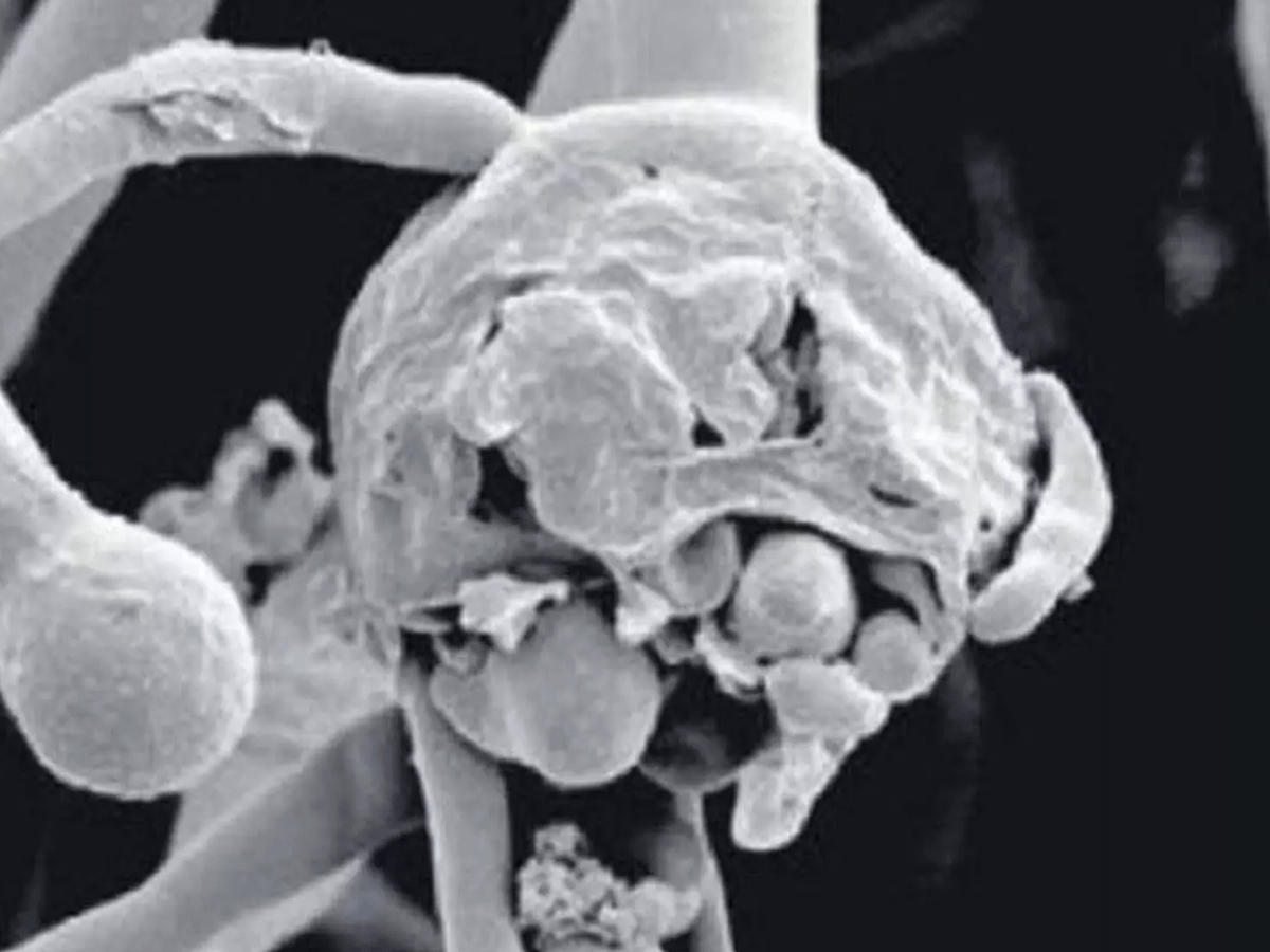 బ్లాక్‌ ఫంగ‌స్ త‌ర్వాత‌.. ఇప్పుడు వైట్‌ ఫంగ‌స్ ఇబ్బందులు