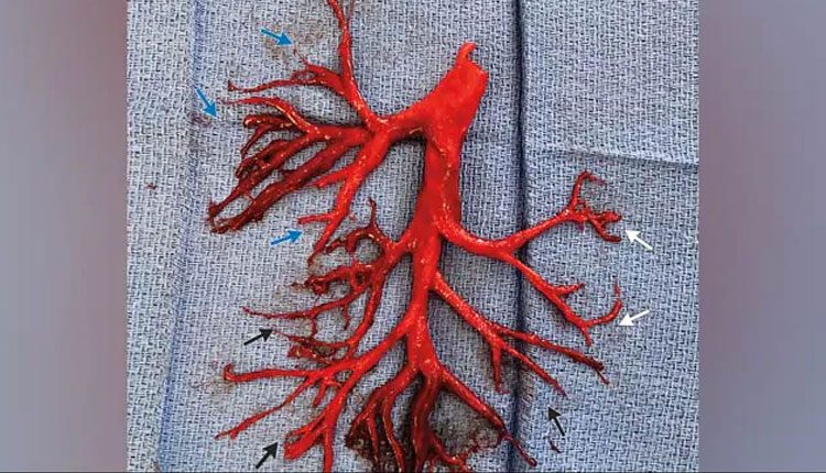 కోవిడ్‌తో ఊపిరితిత్తులే కాదు.. రక్తనాళాలకూ సమస్యే