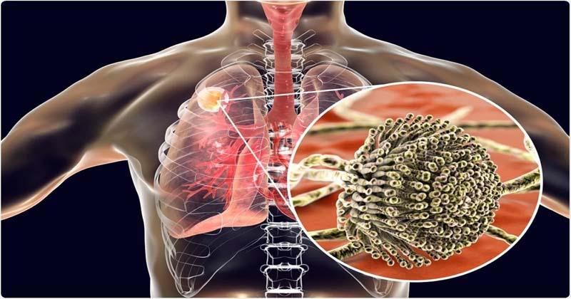 కొవిడ్ పేషెంట్ల‌కు మ‌రో ముప్పు ఆస్ప‌ర్‌గిలోసిస్‌.. ఏంటిది?