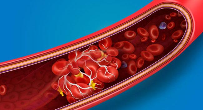 ‘బ్లడ్‌ క్లాటింగ్‌’ లక్షణాలు!