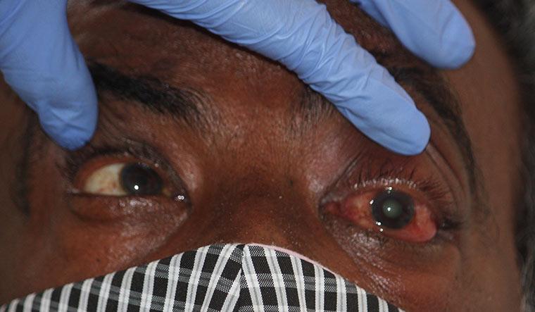 మ‌రో స‌వాల్ : ఢిల్లీని వెంటాడుతున్న‌ బ్లాక్ ఫంగ‌స్ కేసులు!