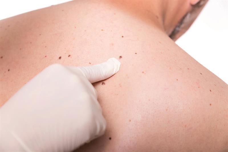 పుట్టుమచ్చలో మార్పులు క్యాన్సర్‌కు సంకేతం