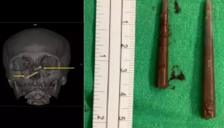 ముక్కులో చెక్క‌పుల్ల‌లు.. వార‌మైనా గుర్తించ‌లేక‌పోయిన మ‌హిళ‌..!