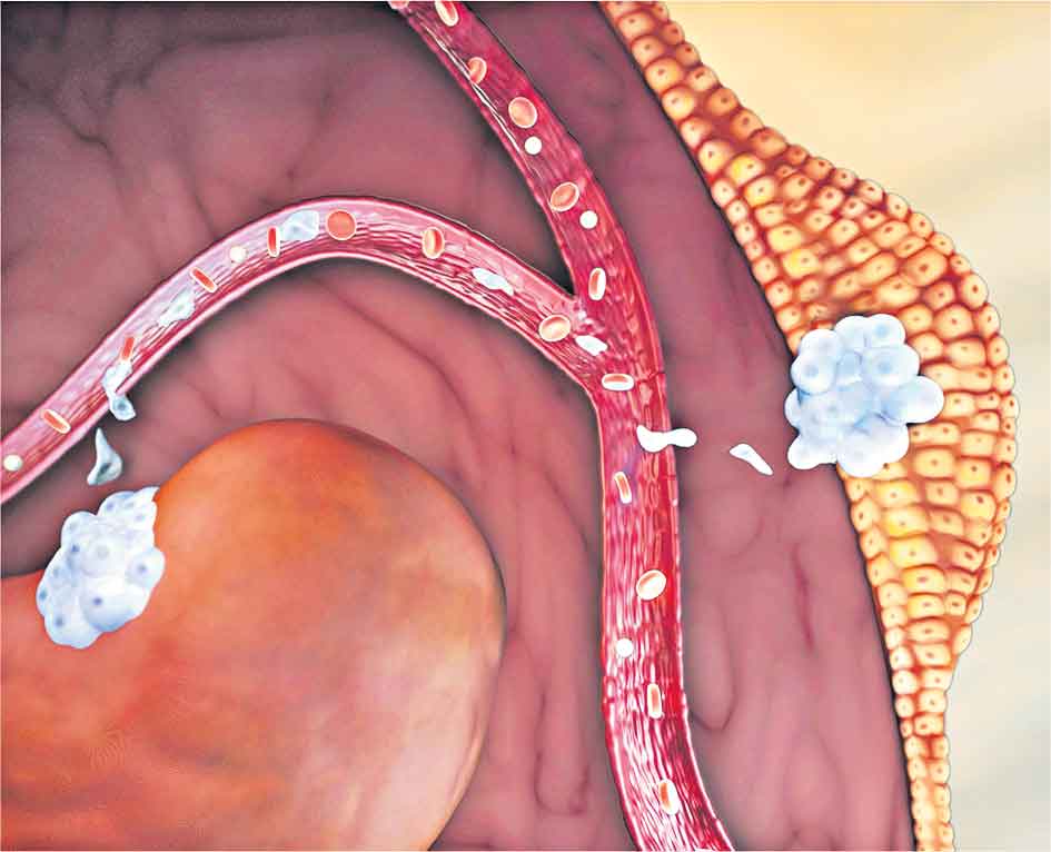 కొత్త ప్రొటీన్‌తో అడ్డుకట్ట