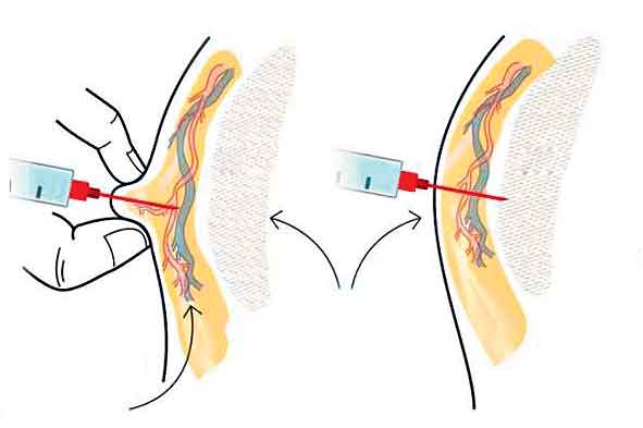 టీకా సూది సరిగ్గా పొడవకపోతే రక్తం గడ్డకట్టే ప్రమాదం