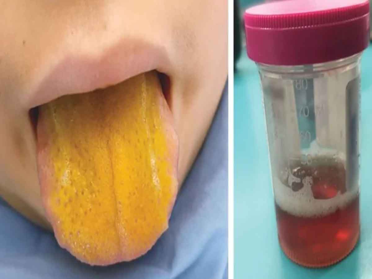 పసుపు రంగులో నాలుక.. బాలుడికి అరుదైన రుగ్మత