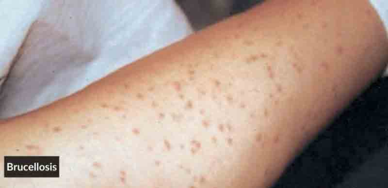 బ్రూసెల్లోసిస్‌.. బహుపరాక్‌..