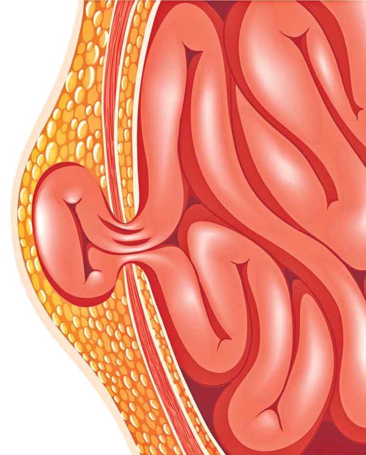 హెర్నియాపై.. శస్త్ర అస్త్రం!