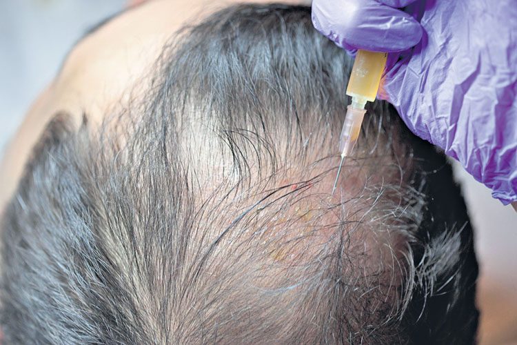 బట్టతలతో బాధపడుతున్నారా? ఇదిగో గుడ్‌న్యూస్‌