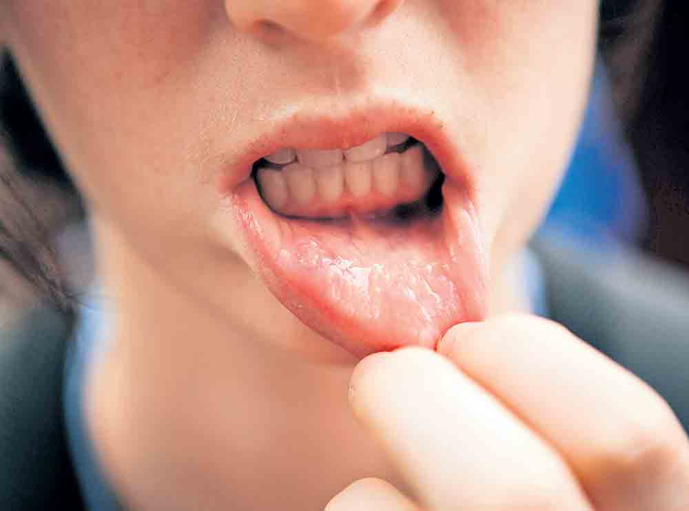 నోటి క్యాన్సర్‌లో మన దేశానిదే మొదటి స్థానం