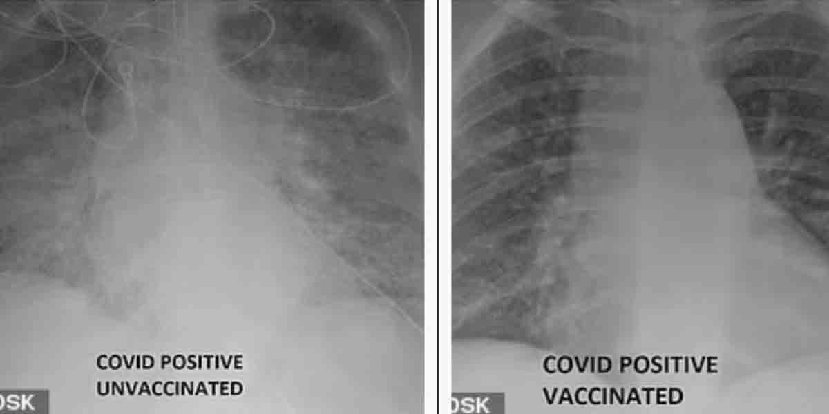Covid-19 Vaccine : వ్యాక్సిన్‌ ఎందుకు తీసుకోవాలి? ఈ ఎక్స్‌రేలు ఏం చెబుతున్నాయ్‌?