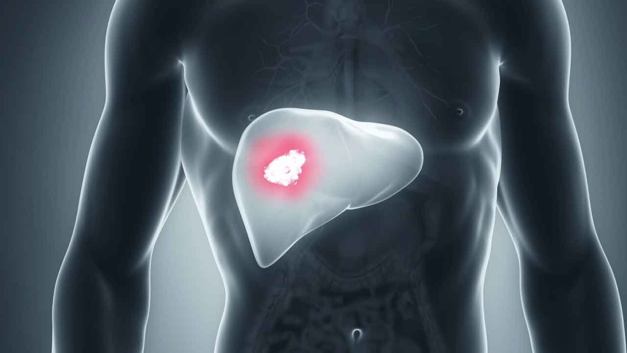 Liver Cancer | పెరుగుతున్న లివర్‌ క్యాన్సర్‌