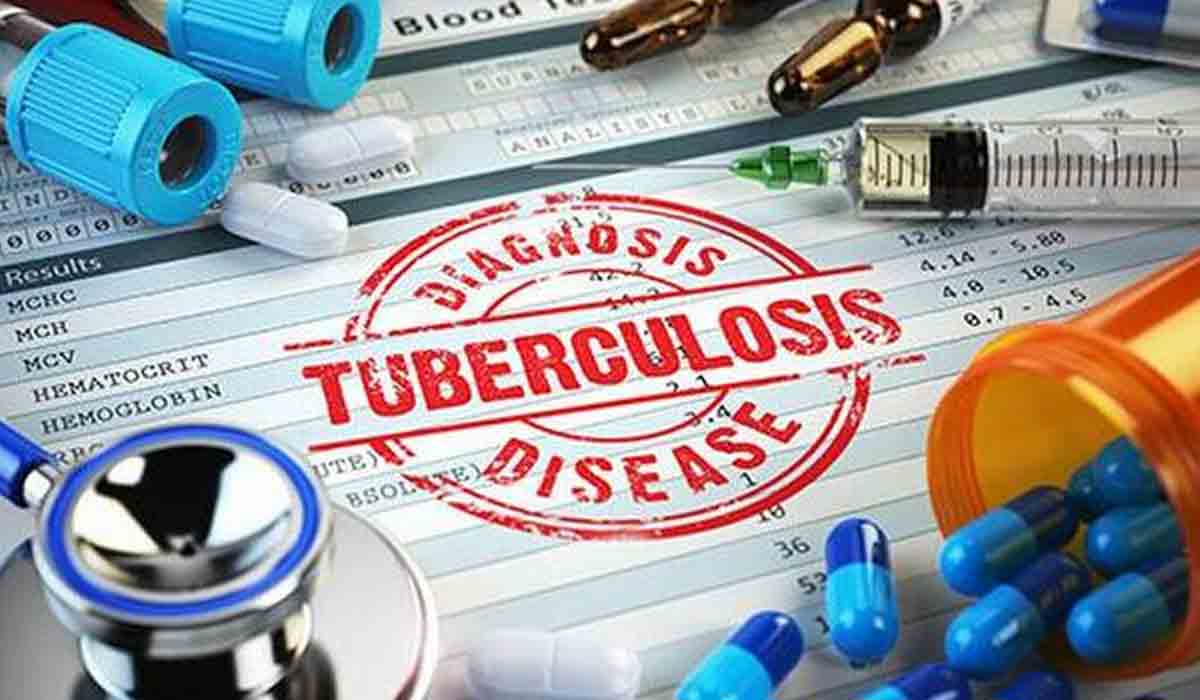 Tuberculosis | కొవిడ్ నుంచి కోలుకున్న 155 మందిలో టీబీ ల‌క్ష‌ణాలు