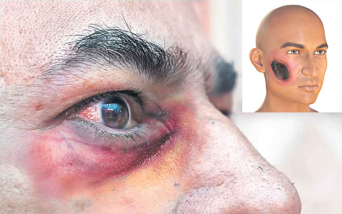 Mucormycosis Black Fungus | ఫంగస్‌పై.. ఆయుష్‌ ఆయుధం సక్సెస్‌