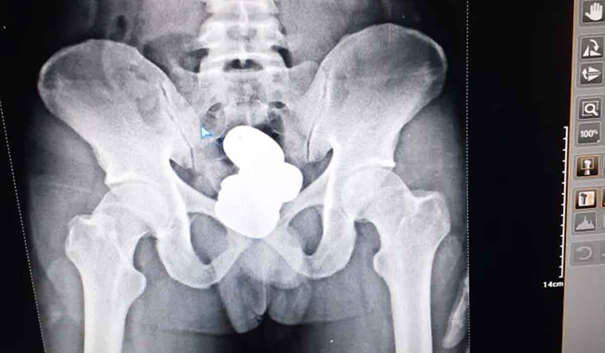 మ‌లాశ‌యంలో 900 గ్రాముల గోల్డ్ పేస్ట్‌.. ఎక్స్-రే తీస్తే దొరికాడు