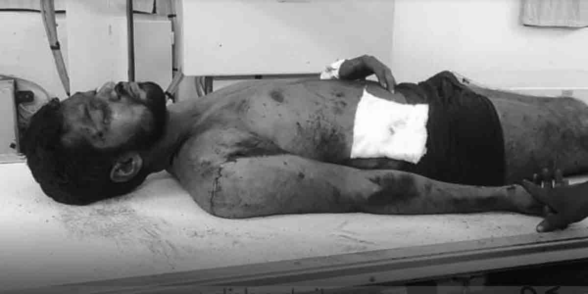 బొగ్గుగనిలో గోడ కూలి సింగరేణి కార్మికుడికి తీవ్ర గాయాలు