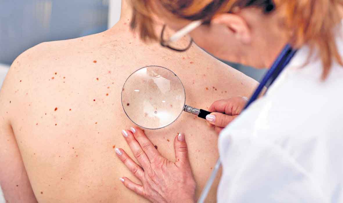 Cancer | పుట్టుమచ్చలో మార్పులు క్యాన్సర్‌కు సంకేతం