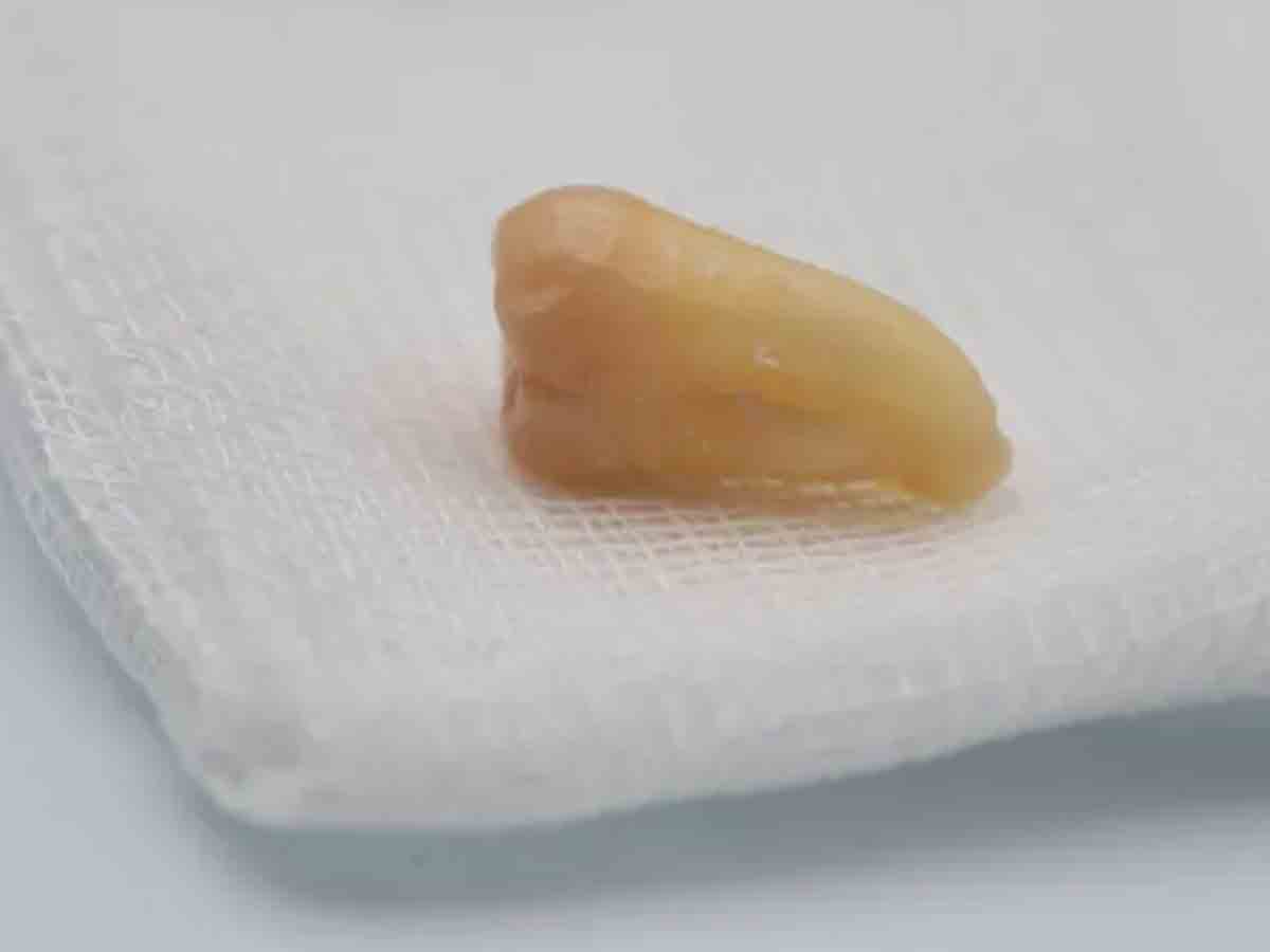 వింత ఆచారం.. మరణించిన వ్యక్తి దంతాలు పీకి బంధువులకు పంపిణీ