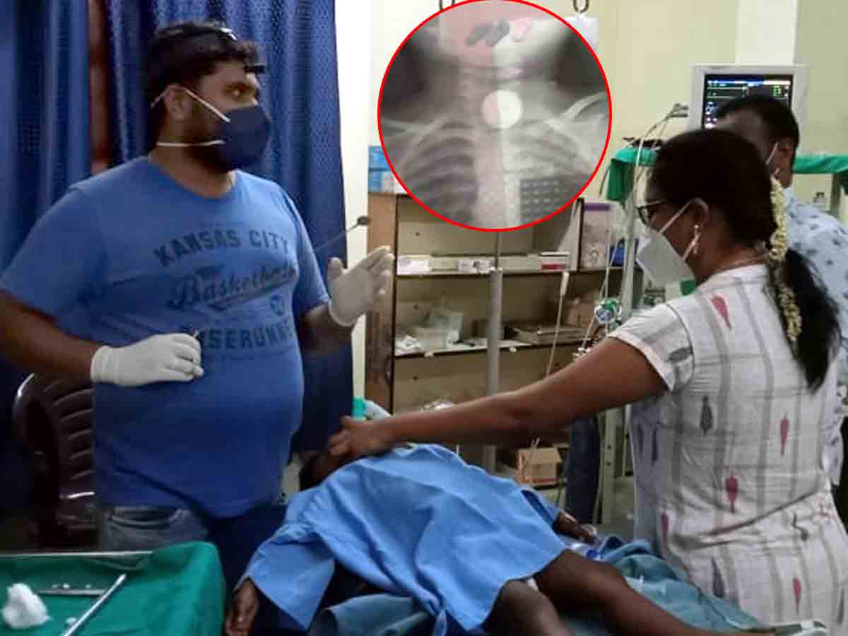 Narsampeta : తప్పిన ప్రమాదం.. మింగిన నాణేం తొలగింపు