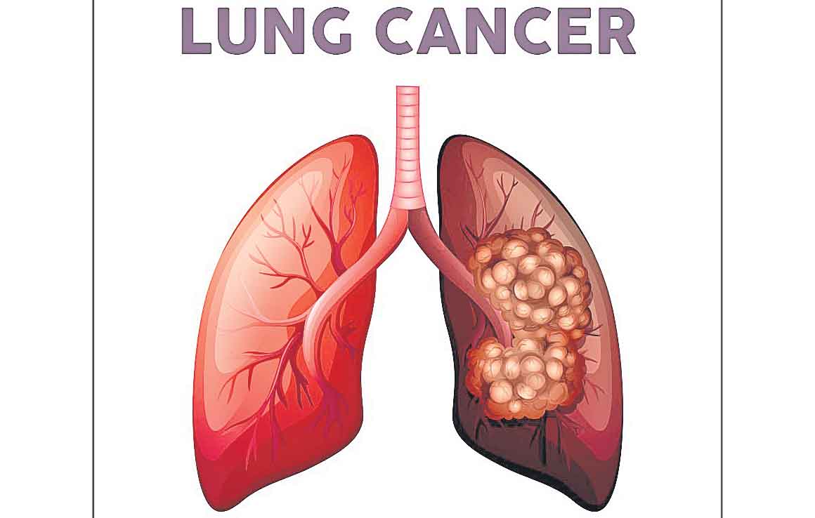 నాలుగేండ్లలో మరింత క్యాన్సర్‌ ముప్పు