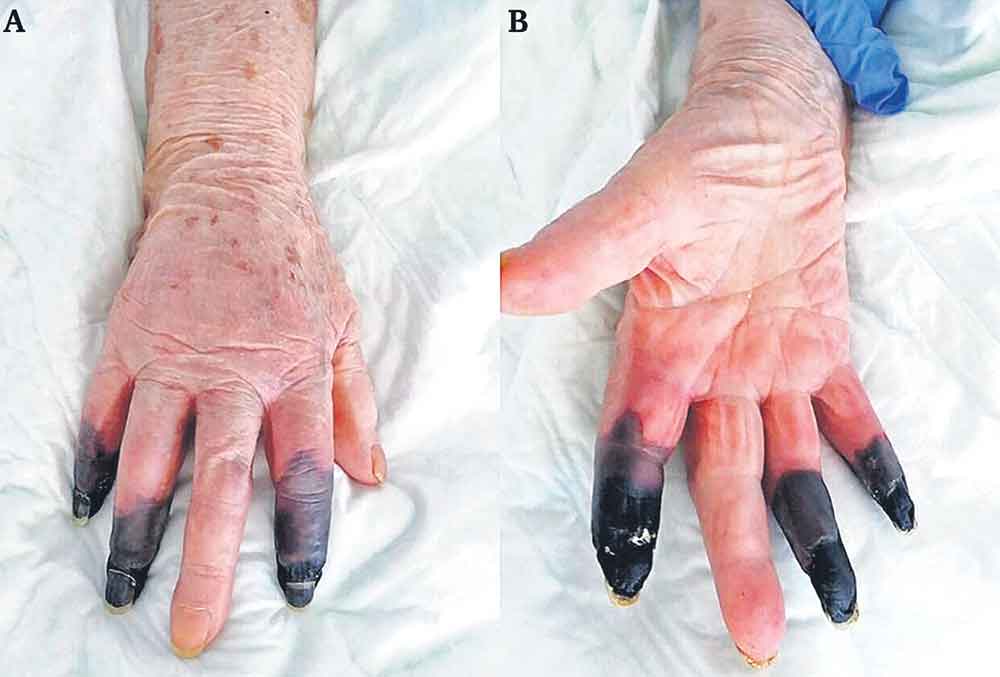 గ్యాంగ్రిన్‌ రూపంలో కరోనా ముప్పు!