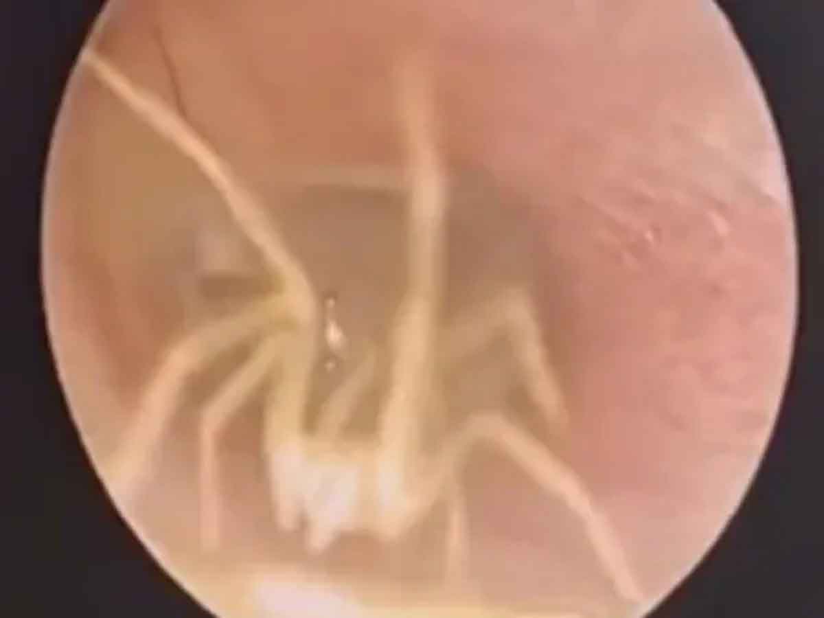 Spider inside Woman’s Ear : మ‌హిళ చెవిలో దూరిన సాలీడు..