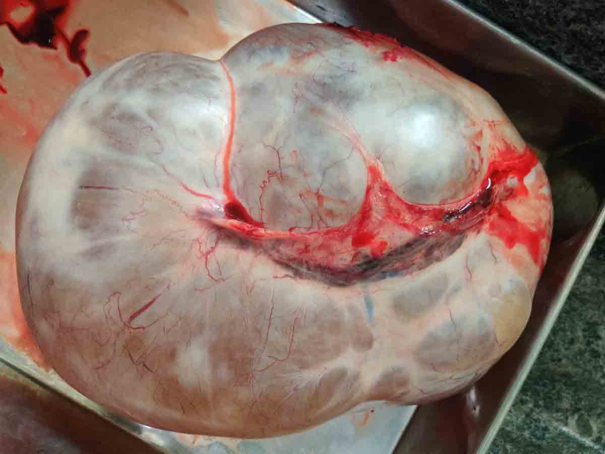 Kalluru | మహిళ కడుపులో ఎనిమిది కేజీల కణితిని తొలగించిన వైద్యులు..