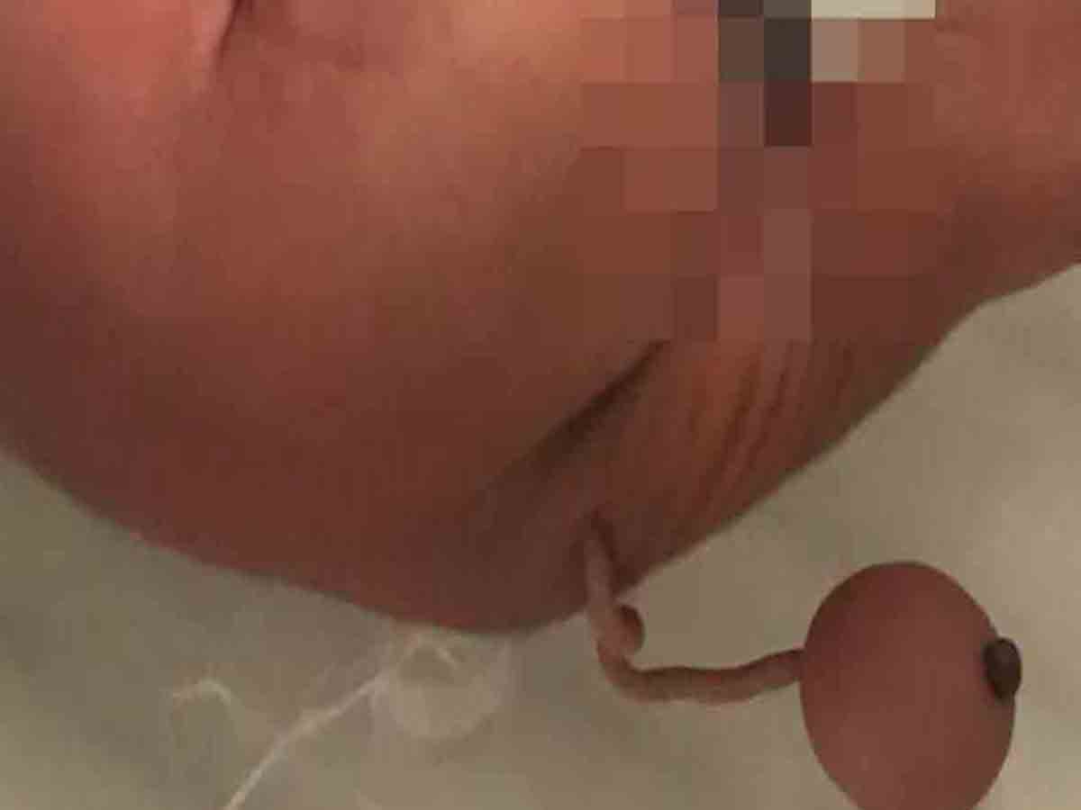 బాల హనుమంతుడు.. తోకతో పుట్టిన శిశువు