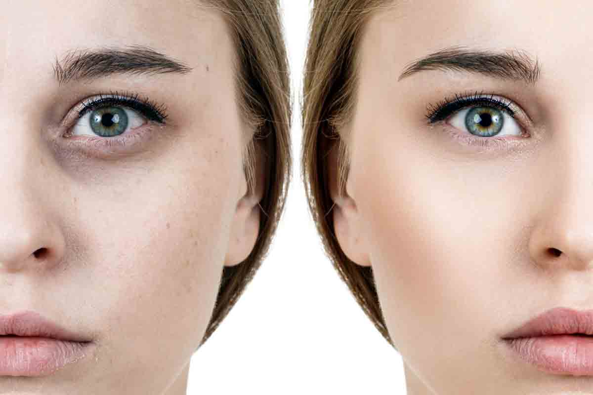 Dark circles | క‌ళ్ల కింద చారాలా? ఇలా చేయండి ఫ‌లితం మీరే చూడండి