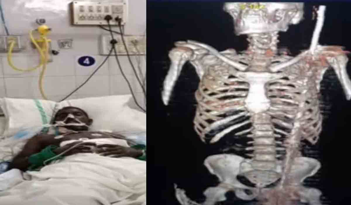 శ‌రీరంలో 3 అడుగుల ఇనుప చువ్వ‌.. స్విమ్స్‌లో స‌ర్జ‌రీ విజ‌య‌వంతం