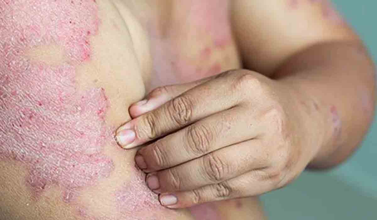 సోరి‌యా‌సి‌స్‌కు త్వరలో ఔషధం.. ఎలు‌క‌లపై ప్రయో‌గా‌నికి కేంద్రం అను‌మతి