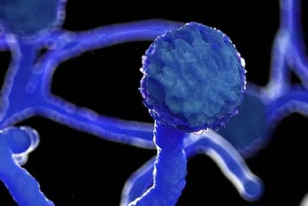 డెంగ్యూ నుంచి కోలుకున్న వ్యక్తికి బ్లాక్‌ ఫంగస్‌