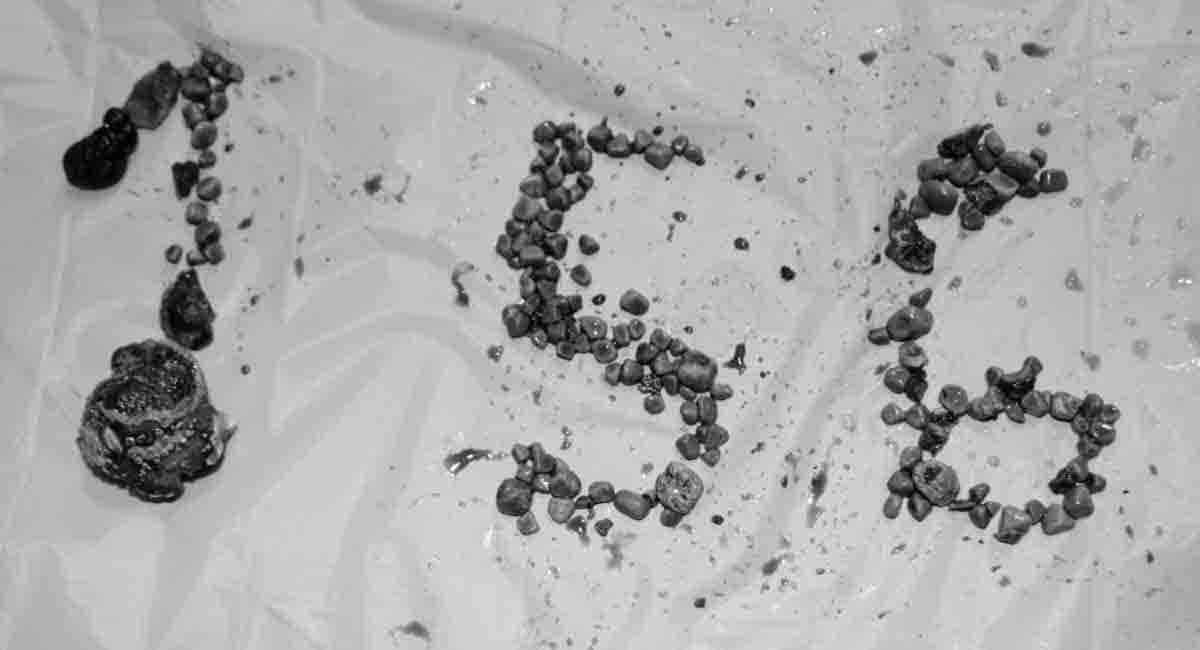 Kidney Stones | కిడ్నీలో 156 రాళ్లు.. డాక్ట‌ర్ల‌కు స‌వాల్‌గా మారిన ఆప‌రేష‌న్‌