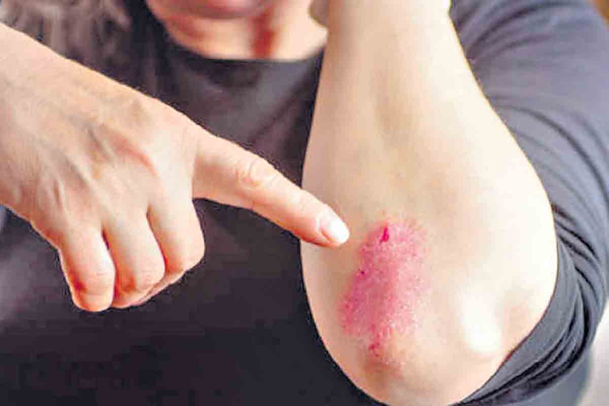 psoriasis | సోరియాసిస్ బాధితుల‌కు గుడ్‌న్యూస్‌.. శాశ్వ‌త ప‌రిష్కారం దొరికిన‌ట్టే