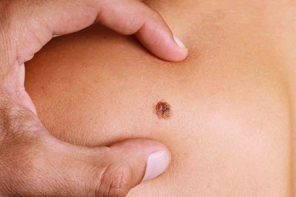 చ‌ర్మ క్యాన్స‌ర్ ఎందుకు వ‌స్తుందో కార‌ణం తెలిసిపోయింది!