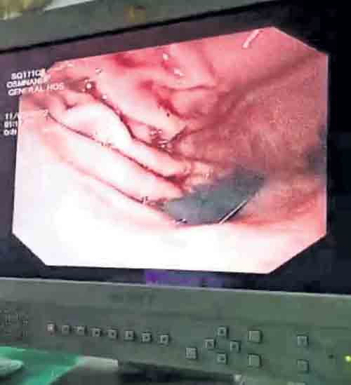 బ్లేడ్‌ను మింగిన బాలిక