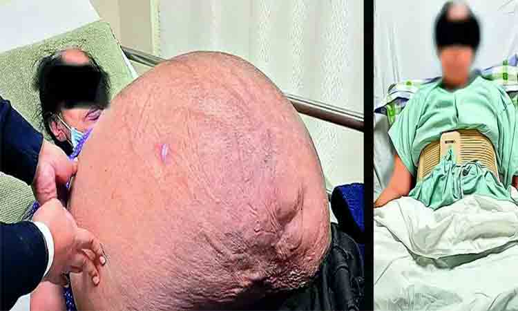 మ‌హిళ క‌డుపులో నుంచి 47 కిలోల క‌ణతి తొల‌గింపు.. ఎక్క‌డో తెలుసా?