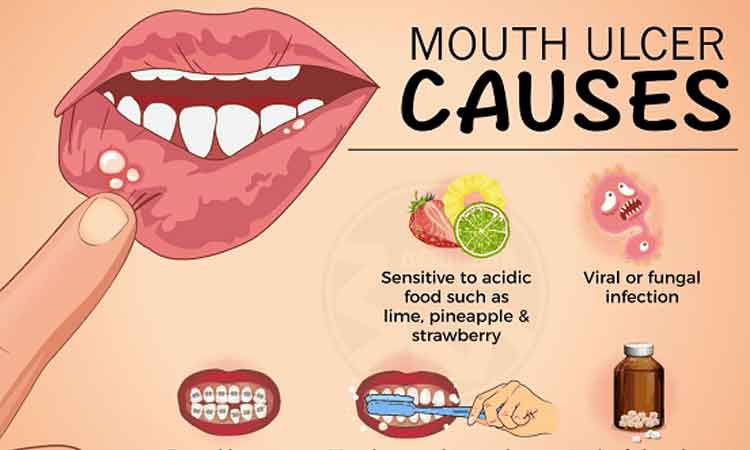 అల్సర్‌ క్యాన్సర్‌గా మారితే?