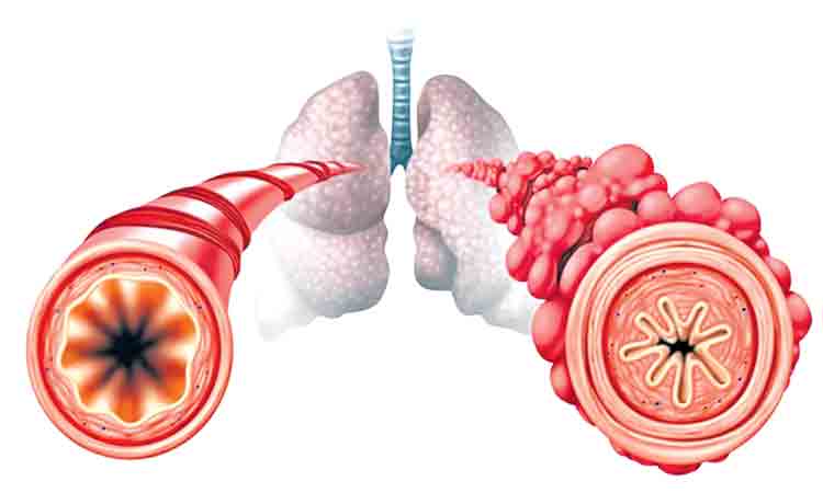 బాబోయ్.. బ్రాంకియోలైటిస్!