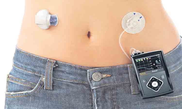 కృత్రిమ క్లోమంతో మధుమేహానికి చెక్‌