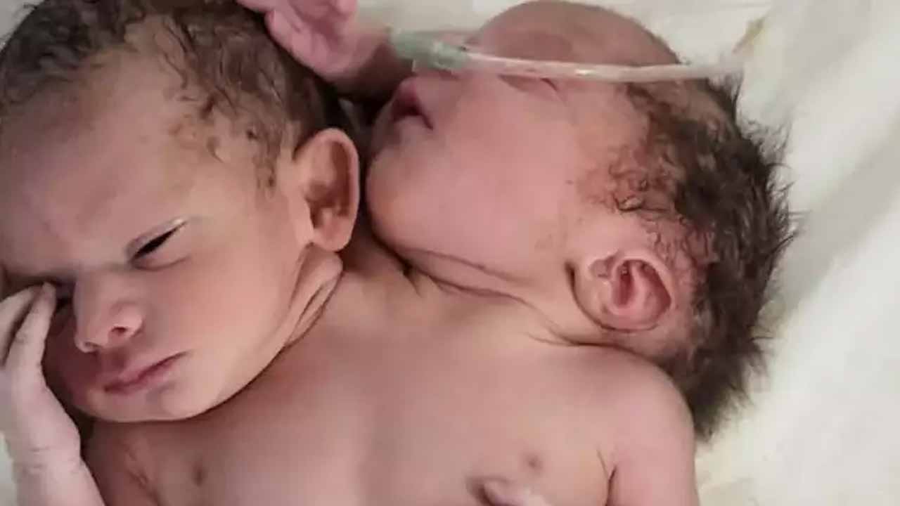 వింత శిశువు జ‌న‌నం..రెండు త‌ల‌లు, రెండు వెన్నెముక‌లు, మూడు చేతులు..!!